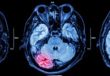 Tratamiento indemnizatorio del daño cerebral Cerebro dañado