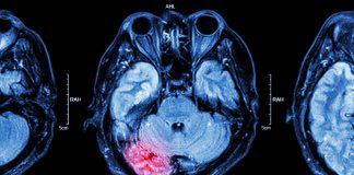 Tratamiento indemnizatorio del daño cerebral Cerebro dañado