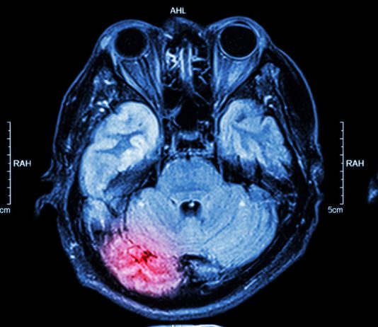 Tratamiento indemnizatorio del daño cerebral Cerebro dañado