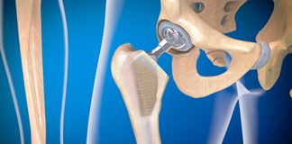 La Fiscalía pide que un fabricante de prótesis de cadera BHR indemnice a los pacientes y que el Estado respalde ese pago